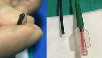 Intracranial Pellet Embolization