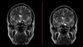 Intraprocedural Rupture of Giant Cavernous ICA Aneurysm in Multiple Intracranial Aneurysm: How Prepared are You for the Disaster?
