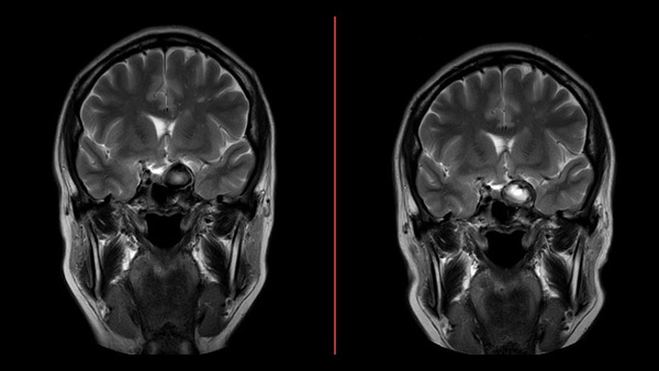 Intraprocedural Rupture of Giant Cavernous ICA Aneurysm in Multiple Intracranial Aneurysm: How Prepared are You for the Disaster?
