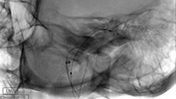 Intraventricular hemorrhage with a high-risk AVM feeder aneurysm