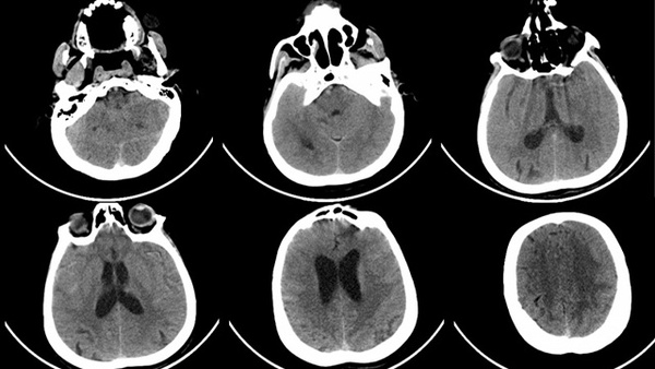 Ipsilateral Transradial Approach For Management Of Ruptured Vertebro-basilar Junction Aneurysm In A Case Of Subclavian Steal Syndrome