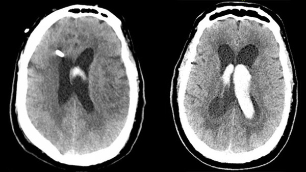 Ischemic stroke and cerebral vasospasm in a COVID-19 patient