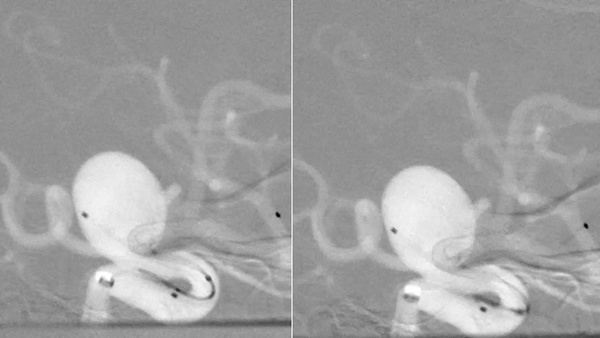 “Jumping” Flow Diverter – an atypical event of Complete device Prolapse- Managing the unforeseen complication