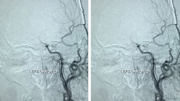 Large aneurysm of right PCA in Moya Moya disease