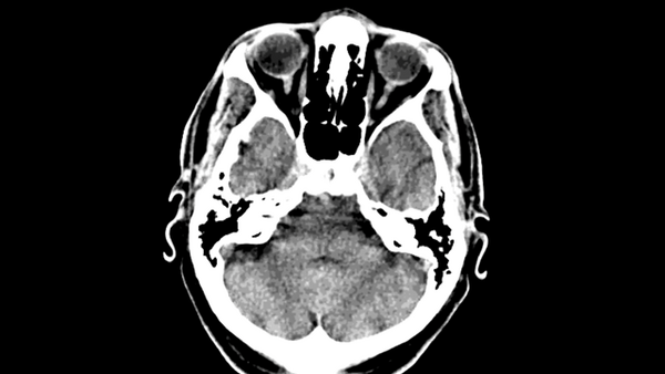 Large neck anterior communicating artery aneurysm: An unusual approach