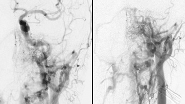 Left anterior condylar confluence (ACC) dural arteriovenous fistula (DAVF) 
