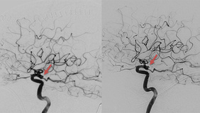 Complex, Rapid Recurrence of Clipped Ruptured Posterior Communicating Artery Aneurysm: Endovascular Management Strategy
