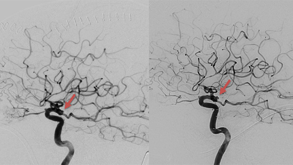 Complex, Rapid Recurrence of Clipped Ruptured Posterior Communicating Artery Aneurysm: Endovascular Management Strategy
