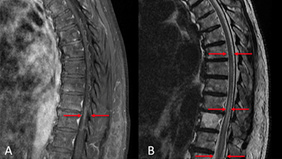 Endovascular management of a thoracic spinal dural arteriovenous fistula (SDAVF) using an EVOH liquid embolic agent