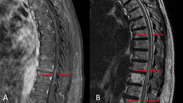 Endovascular management of a thoracic spinal dural arteriovenous fistula (SDAVF) using an EVOH liquid embolic agent