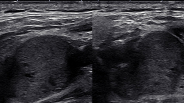 Endovascular Treatment Of Carotid Body Tumor With Embospheres