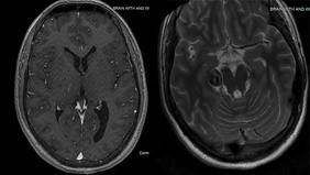 Fusiform Posterior Cerebral Artery Aneurysm Coil Embolization