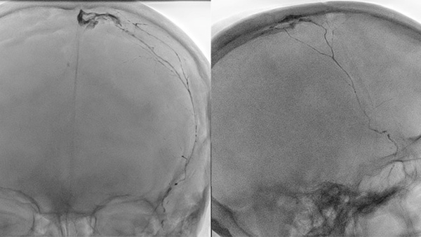 Incidental cerebral venous thrombosis during Middle Meningeal Artery embolization with Squid for chronic subdural hematoma