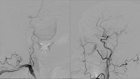 Mission: Impossible - An acom aneurysm with almost no access