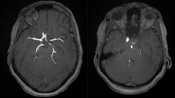Recanalization of late internal carotid artery occlusion after implantation flow-diverter stent implantation