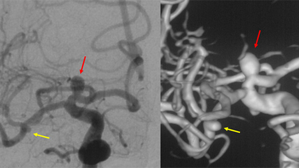 An a1 segment aneurysm treated using intrasaccular flow diverter