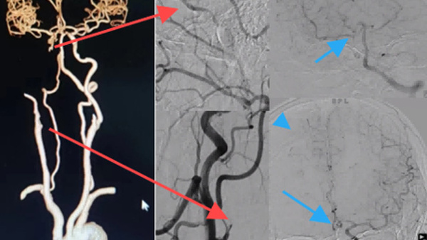 Application of basis-stent technique in chronic ICAS related occlusion
