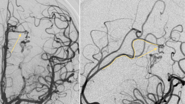 AVM in pregnancy