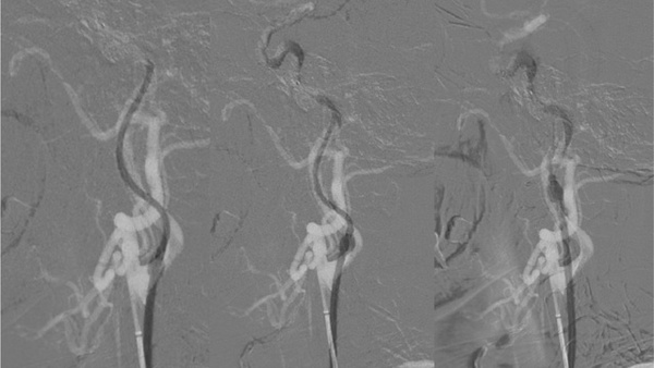 Balloon clear thrombus technique for embolic tandem occlusion