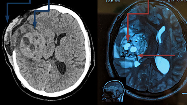 Beyond the arteries: direct tumor puncture for optimal embolization