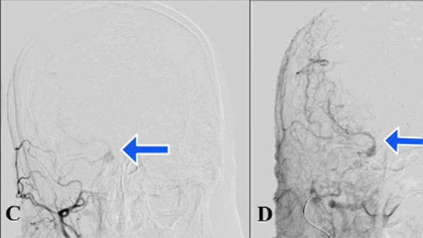 Beyond the ICA: harnessing ECA collaterals for brain perfusion