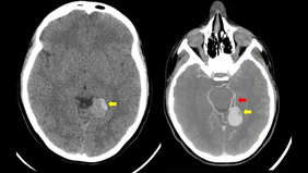 Defusing the Risk: Balloon test occlusion in the management of a giant pediatric aneurysm