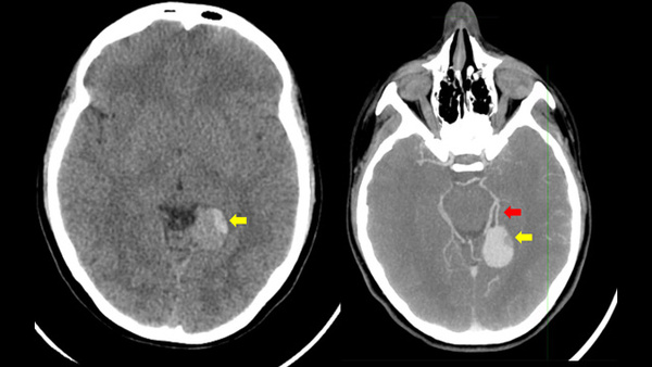 Defusing the Risk: Balloon test occlusion in the management of a giant pediatric aneurysm