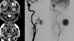 Eagle's edge: vascular injury associated with styloid elongation