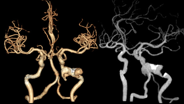 Huge thrombotic aneurysms in C3-C4 segments of internal carotid artery treated by using LEO and Tubridge Stents