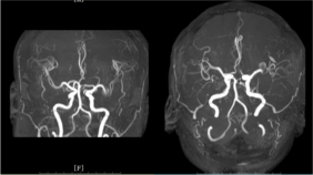 M2 occlusion after endovascular treatment of left MCA bifurcation aneurysm with the Taijie® intrasaccular flow disruption device