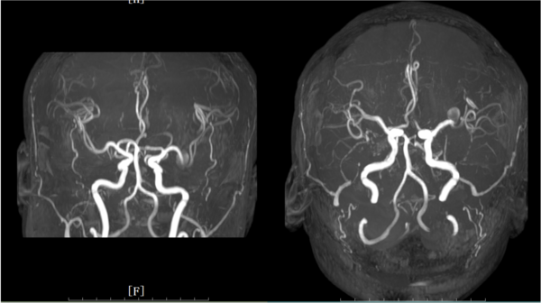 M2 occlusion after endovascular treatment of left MCA bifurcation aneurysm with the Taijie® intrasaccular flow disruption device