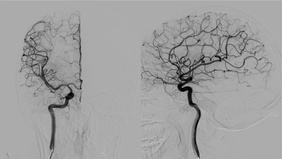 Reconstruction or destruction? A ruptured giant FPCA aneurysm