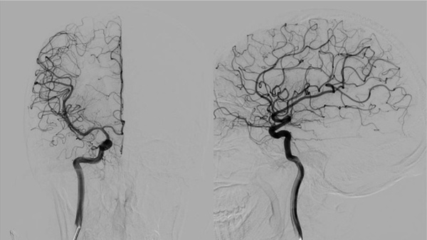 Reconstruction or destruction? A ruptured giant FPCA aneurysm