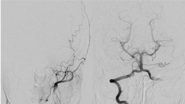 Red eyes, red flags: tackling sphenoid wing dural AV fistula through percutaneous transorbital route
