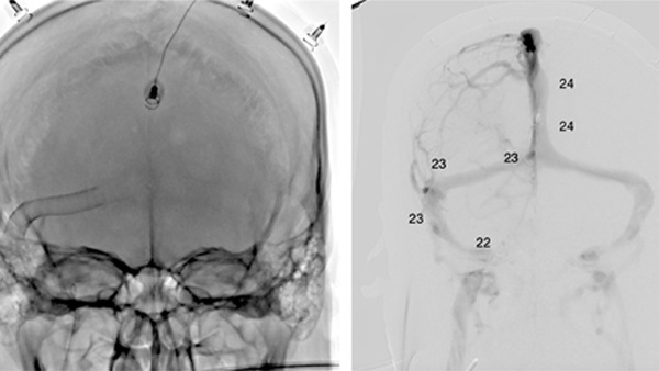 Trust the zebra: rethinking venous stenosis in EDS
