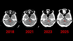 A Large Fusiform Basilar Artery Aneurysm with the AICA Originating from the Dome