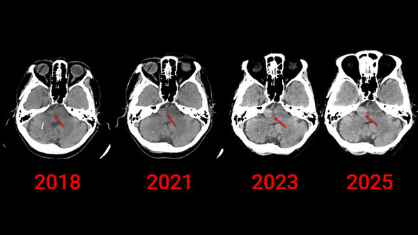 A Large Fusiform Basilar Artery Aneurysm with the AICA Originating from the Dome