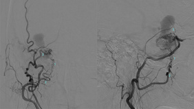 A Skull Base Trap: Dangerous Anastomoses in a Sphenoparietal Sinus Dural AVF