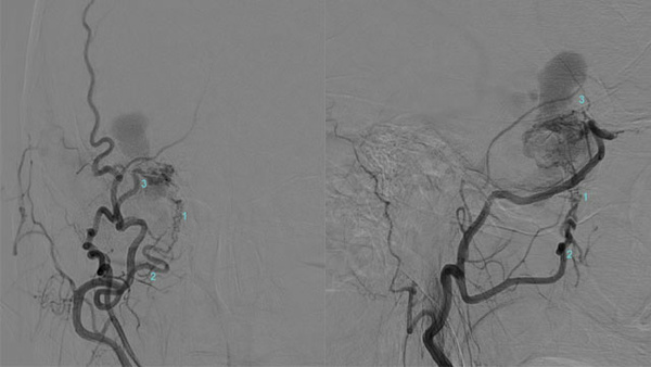 A Skull Base Trap: Dangerous Anastomoses in a Sphenoparietal Sinus Dural AVF