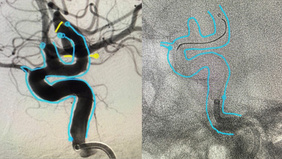Aspiration - Assisted Flow Diverter Deployment: A technical case report