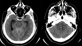 Cerebral Arteriovenous Malformation - Dural Tentorial Fistula with Pial Component