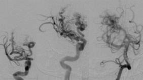Grade IV Thalamic Arteriovenous Malformation Treated with trans-arterial and trans-venous staged embolization
