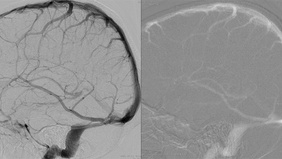 High-Fidelity Venous Sinus Manometry in Idiopathic Intracranial Hypertension