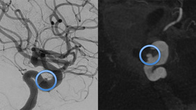 Never too late for bleeding: flow diversion in ICA pseudoaneurysm 16 years after transsphenoidal surgery