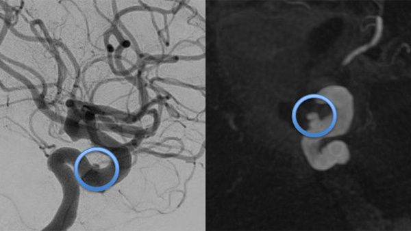 Never too late for bleeding: flow diversion in ICA pseudoaneurysm 16 years after transsphenoidal surgery