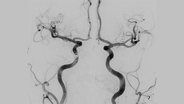 Petro-clival Dural AVFs: Curative Endovascular Strategies and a Novel CARP Technique