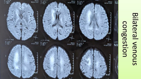 Reaching the Vein from the Artery: A Salvage Strategy in Complex Torcular DAVF