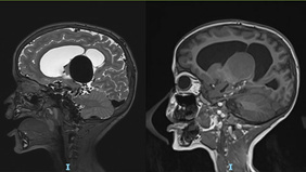 Sequential embolization of VOGM in a pediatric patient: an endovascular management challenge