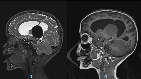 Sequential embolization of VOGM in a pediatric patient: an endovascular management challenge