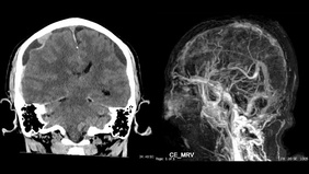 SSS thrombosis with CSDH